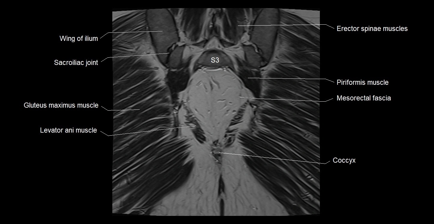 MRI coronal cross sectional anatomy male pelvis image 36.webp